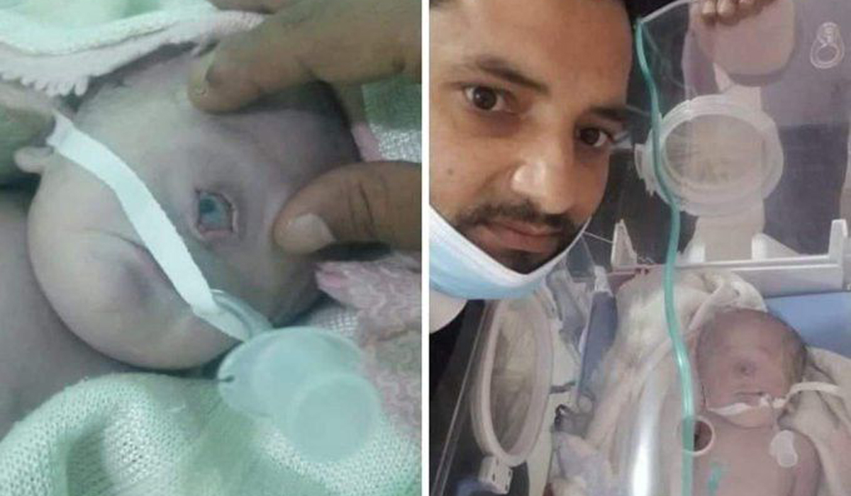 One-eyed baby born in Yemen dies 7 hours later